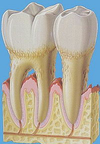 http://www.stdaniel.rusmedserv.com/files/periodontitis.jpg